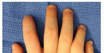 Mastering Polydactyly: Preaxial and Postaxial Types Explained