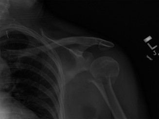 Illustration of humeral shaft fracture - Dr. Mohammed Hutaif