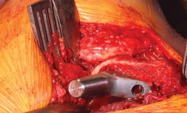 Illustration 9 for The Modified Hardinge Approach: Key Surgical Insights