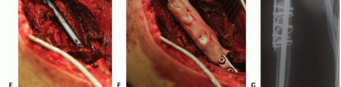 Illustration 30 for Restore Vital Function: Surgery for Type II Humeral Metastasis