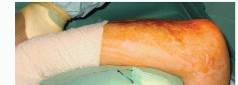 Illustration 5 for Distal Humeral Fractures: When Is Elbow Replacement the Best Option?