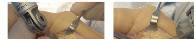 Illustration 15 for Plantar Plate Repair: End Lesser Toe Pain & Instability