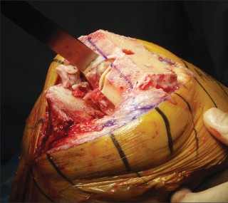 Illustration 4 for Posterior Cruciate Ligament-Retaining TKA: Navigating Pitfalls
