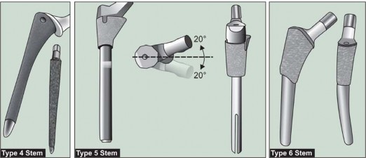 Illustration 50 for Mastering Hip Arthroplasty: Its Evolution and Design Unveiled