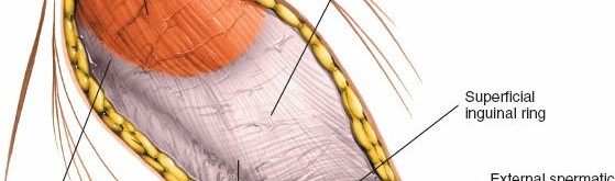 Illustration 6 for Ilioinguinal Approach: Master the Deep Inguinal Ring for Success