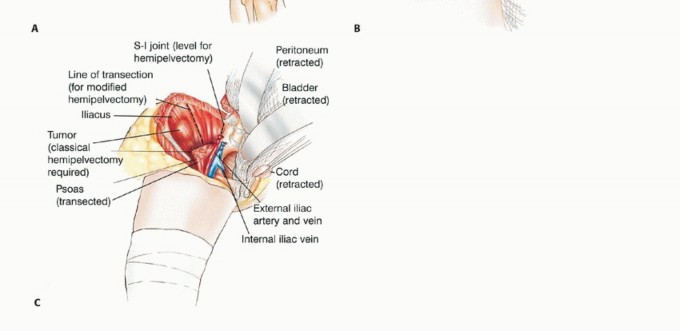 Illustration 12 for Posterior Flap Hemipelvectomy: Mastering Techniques for Optimal Outcomes