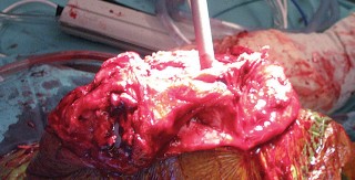 Illustration 34 for Hinged Total Knee: The Salvage Solution for Challenging Cases