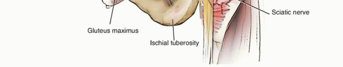 Illustration 4 for Total Hip Arthroplasty: Journey to Preventing Complications