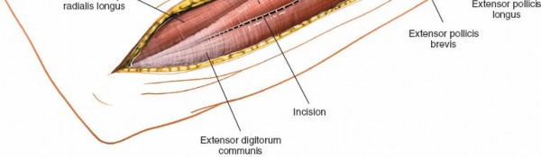 Illustration 8 for Posterior Radius: Expert Tips for Brevis and the Extensor Side