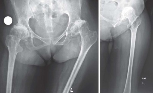 Illustration 5 for Total Hip Arthroplasty: Restoring Mobility in Juvenile Idiopathic Arthritis