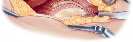 Illustration 48 for Direct Lateral Hip: Optimize Exposure with Sharp Curved Hohmann