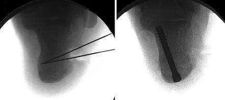 Illustration 94 for First Metatarsal Surgery: Expert Solutions for Foot & Ankle Pain