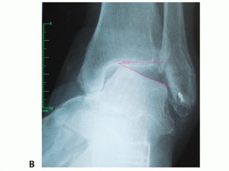Illustration 2 for Unlock Stability: Medullary Nail Fixation for Tibiotalocalcaneal Arthrodesis