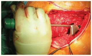 Illustration 23 for Why Polished Tapered Cemented Stems Excel in Hip Replacement