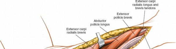 Illustration 9 for Posterior Radius: Expert Tips for Brevis and the Extensor Side