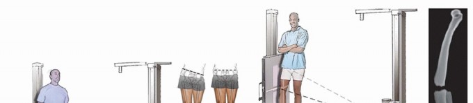 Illustration 3 for Knee Arthrodesis: A Solution for Stable Femur & Tibia Fusion