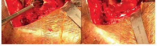 Illustration 11 for Extensively Porouscoated Stems: Proven Success & Superior Fixation