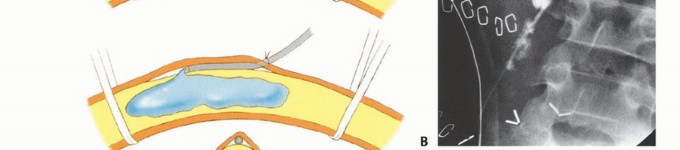 Illustration 18 for Mastering Above-Knee Amputation: Essential Surgical Insights