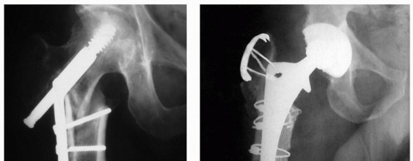 Illustration 10 for Sliding Trochanteric Osteotomy: Modern Role & Refined Techniques
