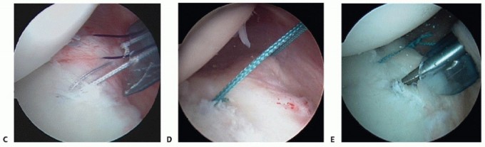 Illustration 8 for Finally Treat Recurrent Posterior Instability of the Shoulder