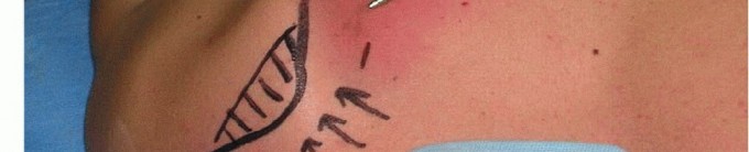 Illustration 26 for Is Your Dorsal Scapular Nerve Causing Snapping Scapula Pain?