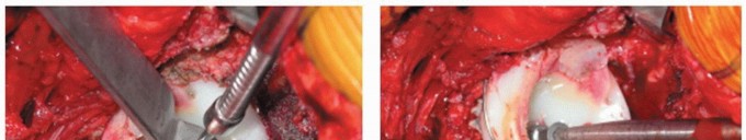 Illustration 5 for Mastering Component Removal: Extended Trochanteric Osteotomy