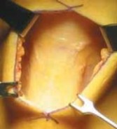 Illustration 7 for Optimizing Single-Bundle Anterior Cruciate Ligament Repair