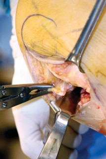 صورة طبية: جراحة استبدال مفصل الركبة الجزئي (UKA): تجنب الأخطاء والاستفادة القصوى في صنعاء مع الأستاذ الدكتور محمد هطيف