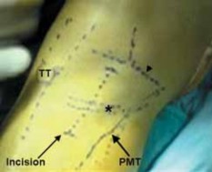 Illustration 20 for Guide Pin Assembly: Key to Flawless Upper Tibial Osteotomy