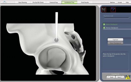 Illustration 26 for Robotics in Total Hip Arthroplasty: A New Era of Precision