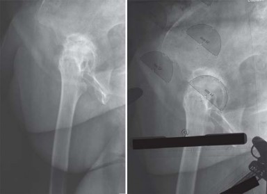Illustration 5 for Maximize Success: Preoperative planning in primary Hip Replacement