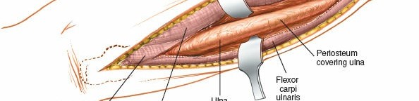 Illustration 50 for Mastering Approaches to the Upper Third of the Radius