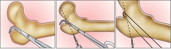 Illustration 4 for Standard Trochanteric Osteotomy: Key to Complex Hip Cases
