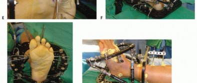 Illustration 65 for Mastering Midfoot Arthrodesis: Protect the Deep Neurovascular Bundle