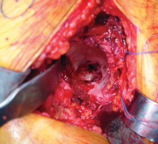 Illustration 29 for Mastering the Cementless Acetabular Cup: Techniques for Optimal Fixation