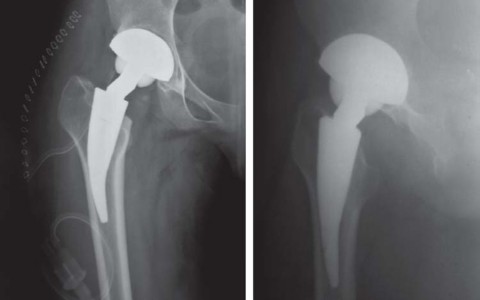 Illustration 46 for Considering METHA Short Stem? Discover Bone-Preserving THA