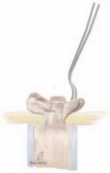 Illustration 16 for Optimizing Instrumentation for Neuromuscular Scoliosis