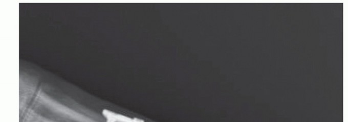 Illustration 75 for End Articular Cartilage Loss: Arthrosurface HemiCAP Resurfacing