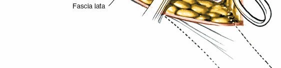 Illustration 35 for Unlocking Every Aspect of the Hip's Surgical Approaches