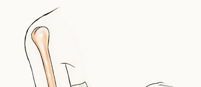 Illustration 34 for Restore Vital Function: Surgery for Type II Humeral Metastasis