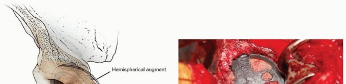 Illustration 6 for Uncemented Acetabular Component: Augments & Cup-Cages for Bone Loss