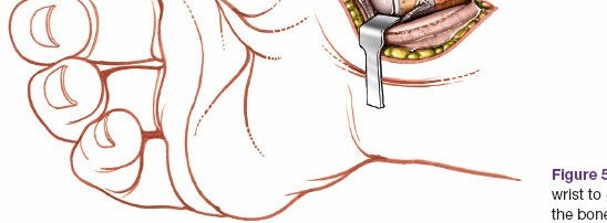 Illustration 189 for Essential Surgical Approaches: Uncover Every Aspect of the Wrist