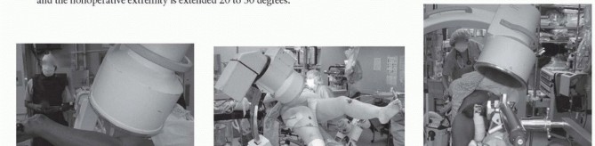 Illustration 11 for Achieve Optimal Femoral Head Fixation with Cephalomedullary Nailing