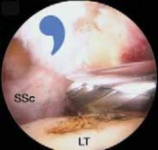 Illustration 28 for Arthroscopic Subscapularis Repair: The lo iky brady Method for Stability