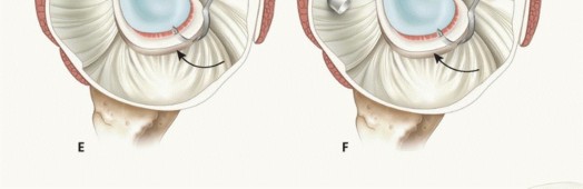 Illustration 19 for Regain Stability: Arthroscopy for Anterior Instability & the Inferior Glenohumeral Ligament