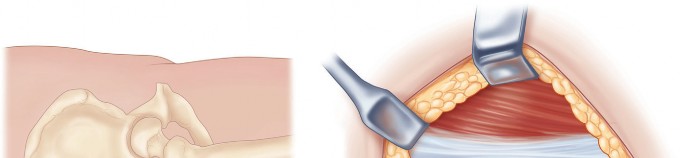 Illustration 20 for Figure Hip Resurfacing: Who Benefits and Who Should Avoid It?