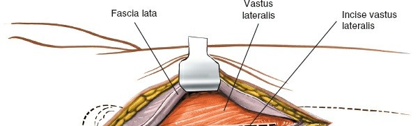 Illustration 7 for Optimal Femoral Approaches: Mastering the Lateral Intermuscular Septum