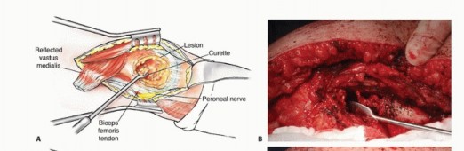 Illustration 38 for Mastering Femoral Metastases: Optimal Function for Femoris & Vastus