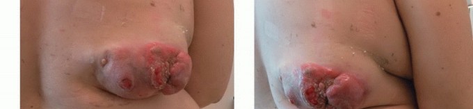 Illustration 16 for Targeted Ablation of Musculoskeletal Tumors: A Safer Approach