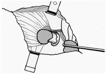Illustration 25 for Sliding Trochanteric Osteotomy: Modern Role & Refined Techniques